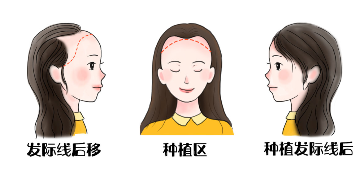 女性发际线种植